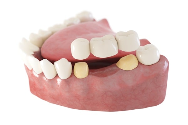 dental-bridges-river-city-dental