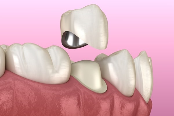 dental-crowns-river-city-dental