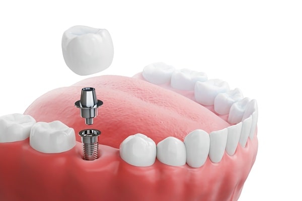 dental-implants-river-city-dental