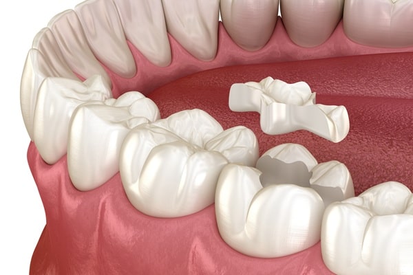 inlays-onlays-river-city-dental
