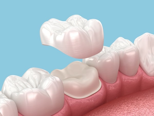what-to-expect-dental-crowns