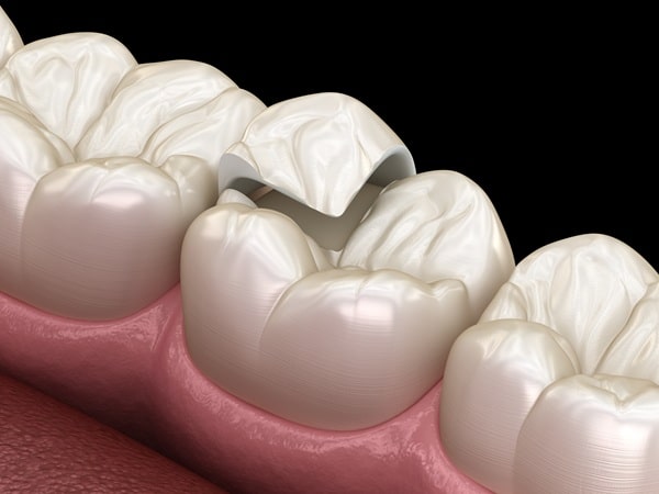 why-inlays-and-onlays-work-well